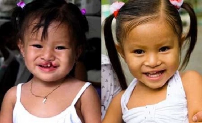 Trẻ bị sứt môi ở hàm ếch nên được phẫu thuật trước 2 tuổi. Ảnh: BVĐHYD.