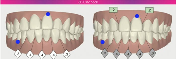Hình cắt ghép từ video 3D Clincheck mô phỏng kết quả điều trị của một khách hàng tại trung tâm.