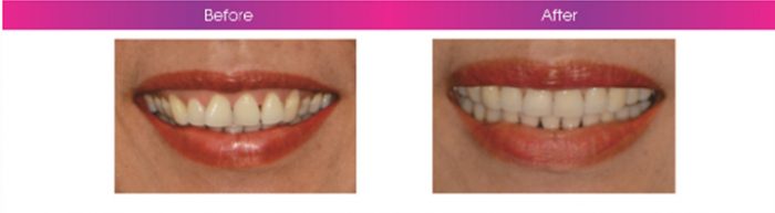 Hình ảnh trước và sau điều trị Invisalign của chị Vĩnh Linh.